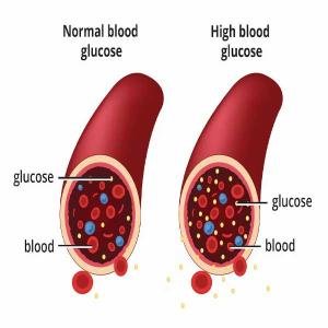 High Blood Sugar Treatment Supplements to Lower Blood Sugar Naturally in Accra, Ghana