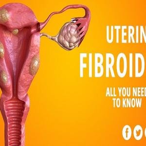 Fibroids Treatment Medication Without Surgery in Accra, Ghana