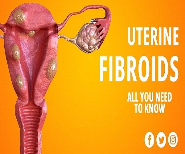 Fibroid Treatment Medication Without Surgery: Symptoms and Causes