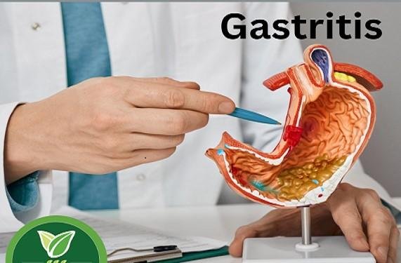 Gastritis Causes| Symptoms | Treatment Medication at Home