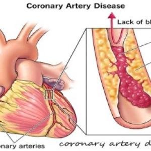 Coronary Artery Disease Treatment Medication in Accra, Ghana