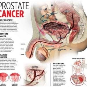 Prostate Cancer Treatment Supplements in Accra, Ghana