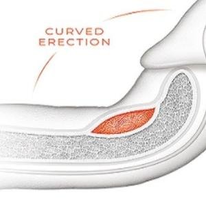 Curved Penis (Penile Curvature) Natural Treatment Cream & Medicine in Accra, Ghana