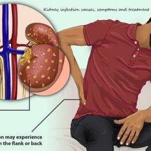 Kidney Infection Treatment Medication in Accra, Ghana