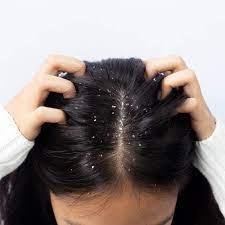 Effects and Harmful Impartations of Dandruff