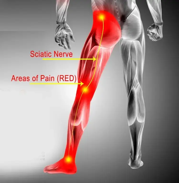 Sciatic Nerve Pain: Causes | Exercises | Immediate Relief | Treatment Medication